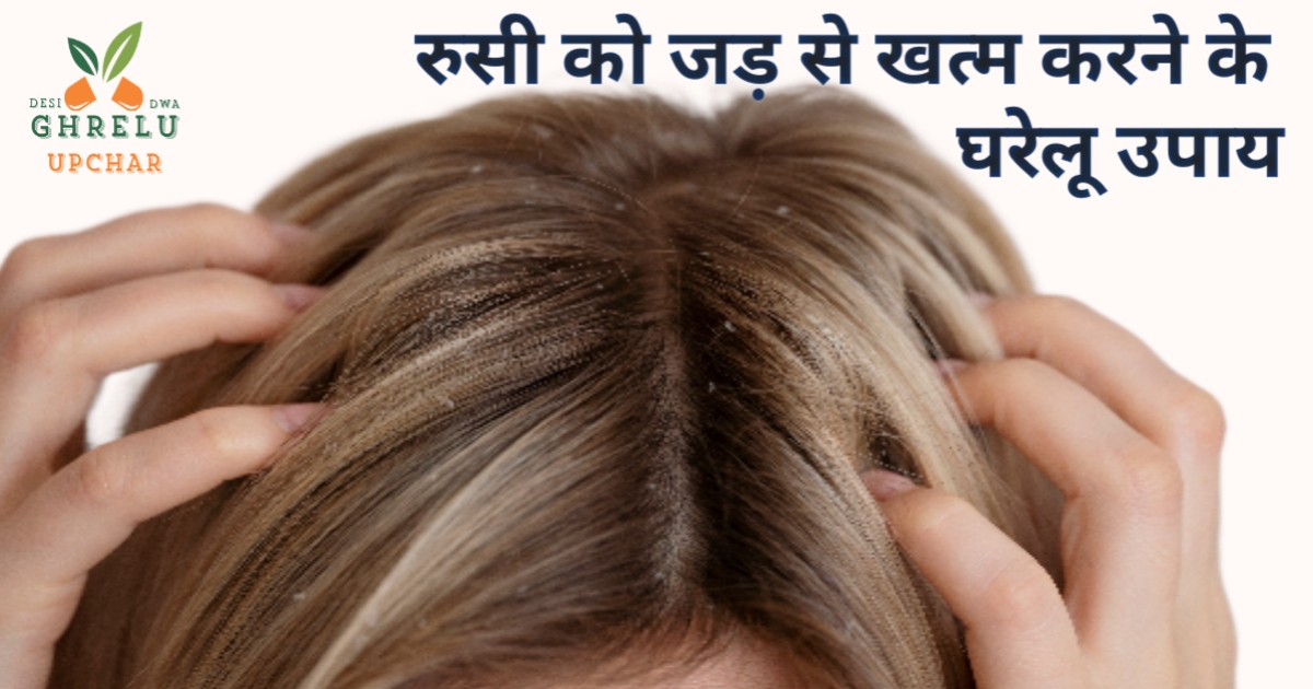 रुसी को जड़ से खत्म करने के उपाय