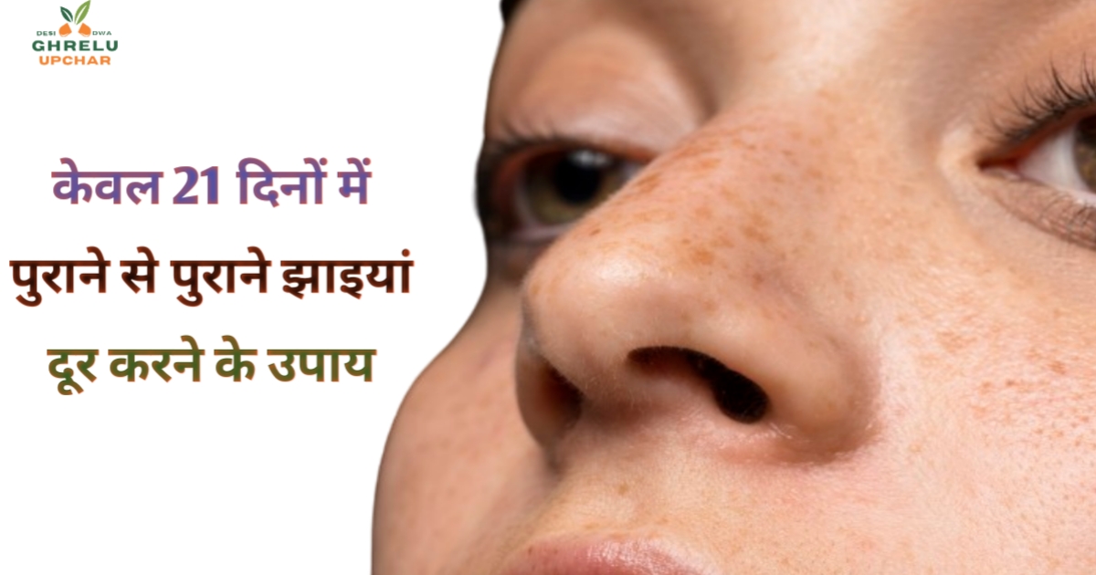 केवल 21 दिनों में पुराने से पुराने झाइयां दूर करने के उपाय